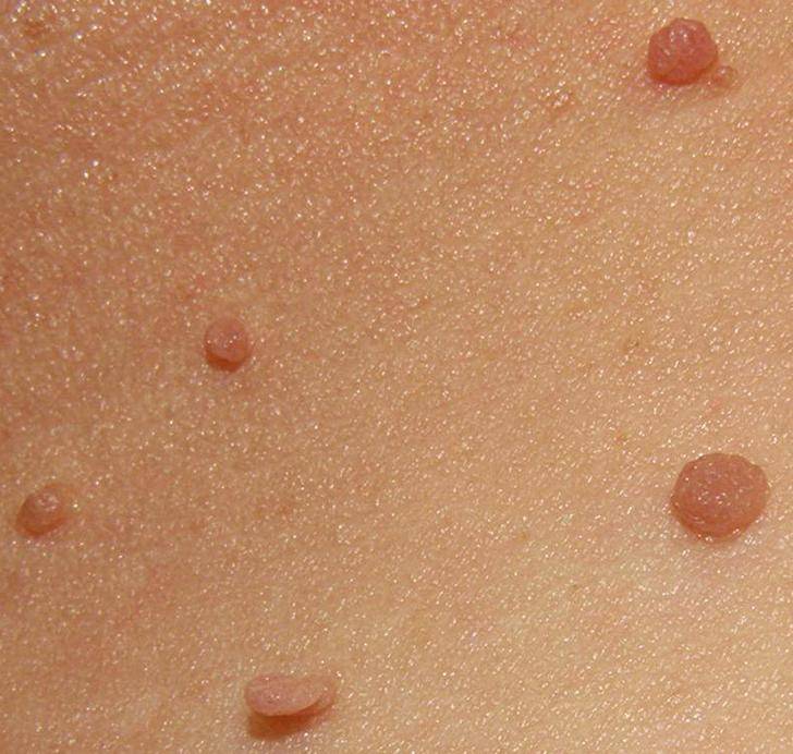 Petite Boule De Sang Sur La Peau Des Testicules