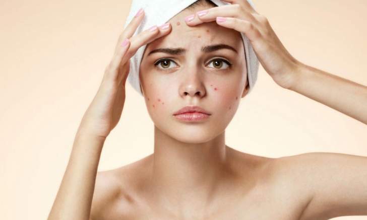 Comment combattre l'acné pour se sentir plus en confiance