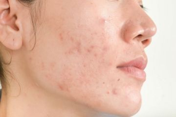 Comment prendre soin de sa peau acnéique