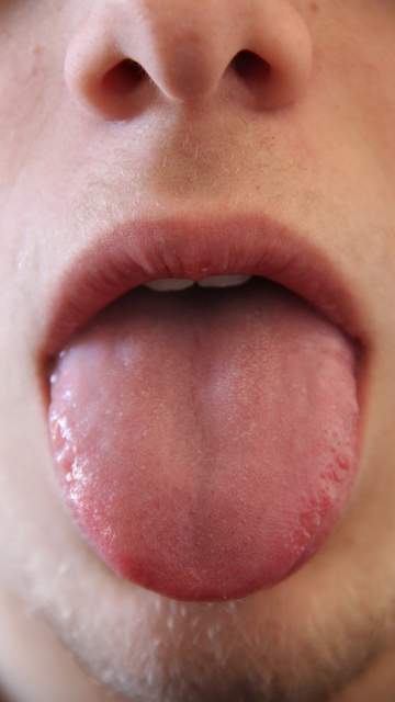 5 traitements naturels contre la Mycose de la bouche