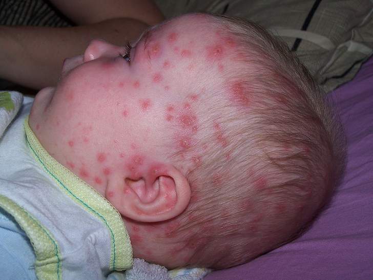 enfant atteint de la varicelle 