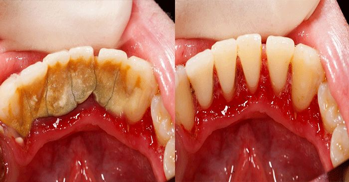 Astuce maison pour enlever le tartre dentaire soi-même