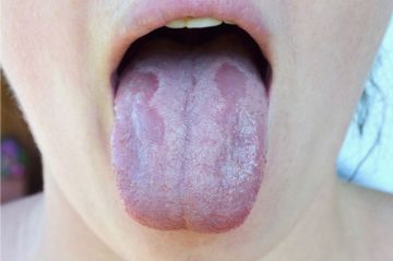 5 traitements naturels contre la Mycose de la bouche