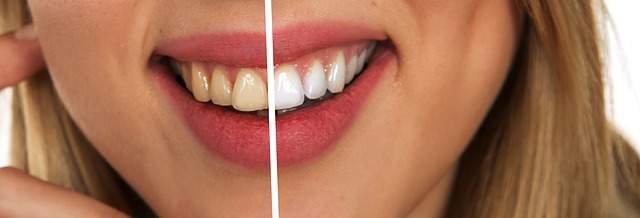 blanchiment des dents avant après