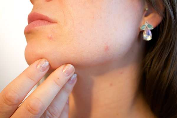 Soin contre l'acné