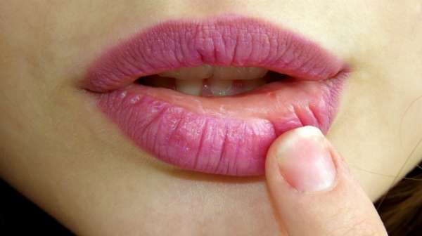 Lèvres gercées