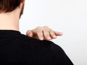 Se débarrasser des pellicules des cheveux