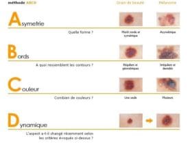 Surveiller ses grains de beauté