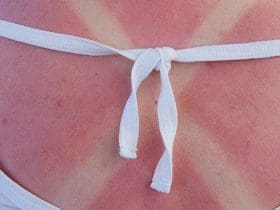 Traiter les coups de soleil