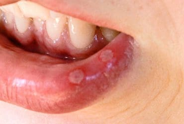 Remèdes maison contre les aphtes