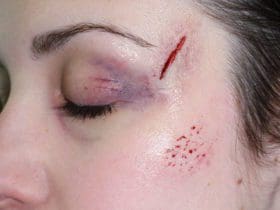 Traiter les cicatrices naturellement