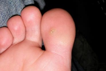 Soigner une verrue avec du thé