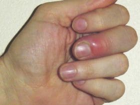 Remède naturel contre le panaris