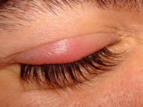 Soigner un orgelet naturellement