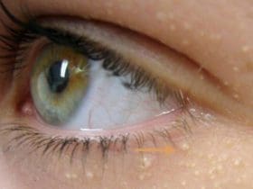 Recettes maison pour traiter les petites boules de graisse sous les yeux