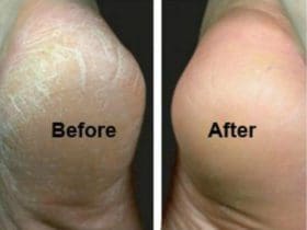 Remède maison contre les talons fendillés