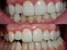 Remèdes naturels contre la gingivite