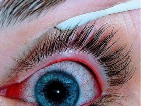 Remèdes naturels contre la conjonctivite