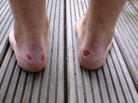 Comment soigner une ampoule au pied