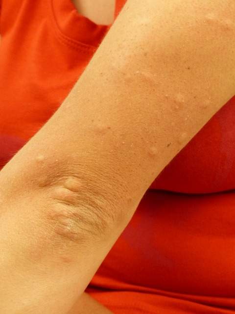 piqûres de moustiques sur le bras