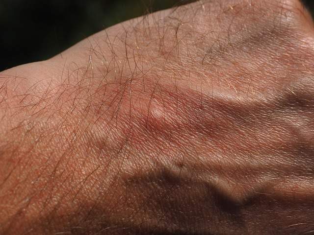 dos d'une main avec une piqûre d'insecte