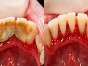 Astuce maison pour enlever le tartre dentaire soi-même