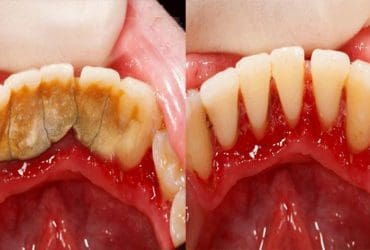 Astuce maison pour enlever le tartre dentaire soi-même