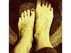 Remèdes naturels contre les crevasses et les talons fendillés