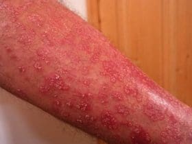 Traitements et remèdes naturels contre le psoriasis