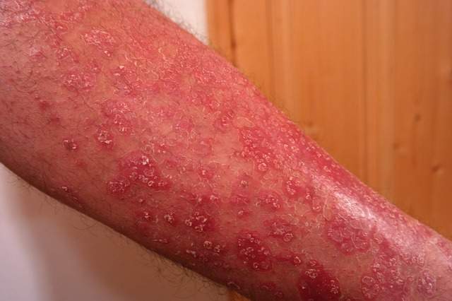 Traitements et remèdes naturels contre le psoriasis