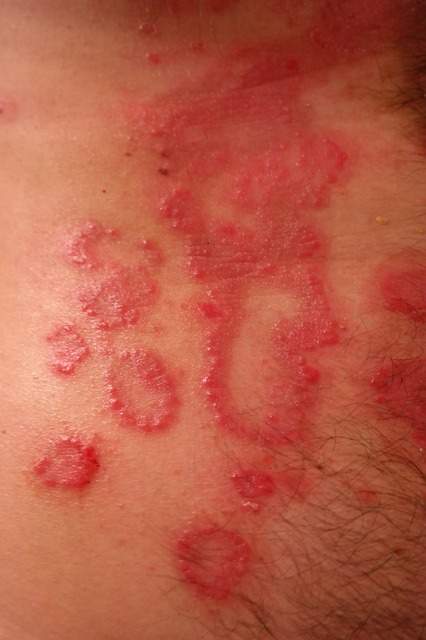 peau atteinte de psoriasis