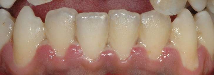 Gencives malades déchaussement dentaire gencives rétractées