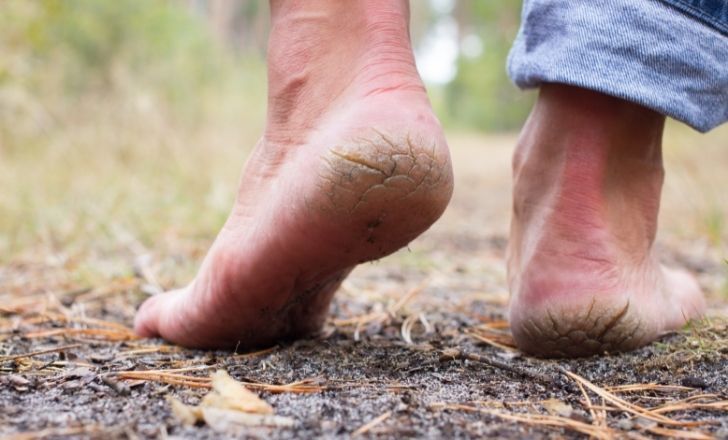 Pieds secs : 6 remèdes naturels pour retrouver des pieds tout doux