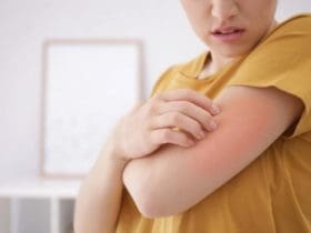 5 façons pour se débarrasser des boutons de chaleur