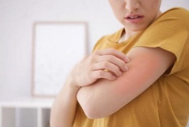 5 façons pour se débarrasser des boutons de chaleur