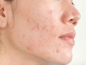 Comment prendre soin de sa peau acnéique