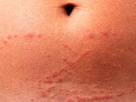 Méduse : ce qu'il faut faire immédiatement après une piqûre