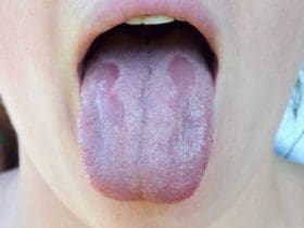 5 traitements naturels contre la Mycose de la bouche