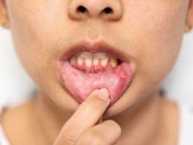 Comment soigner un aphte naturellement ?