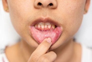 Comment soigner un aphte naturellement ?