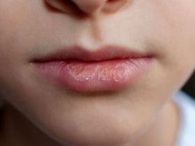 Comment en finir avec les lèvres sèches et gercées