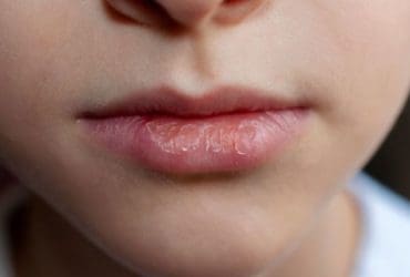 Comment en finir avec les lèvres sèches et gercées