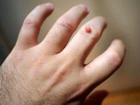 Remèdes naturels contre la verrue